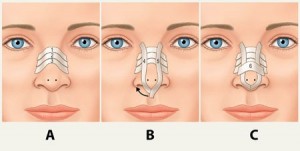چسب بینی بعد از جراحی