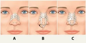 چسب بینی بعد از جراحی