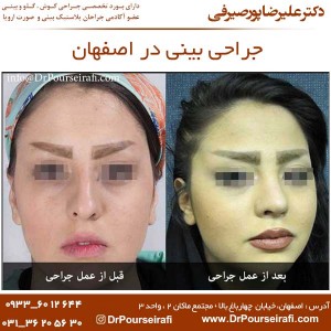 جراحی بینی در اصفهان