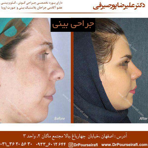 جراحی بینی - دکتر علیرضا پورصیرفی