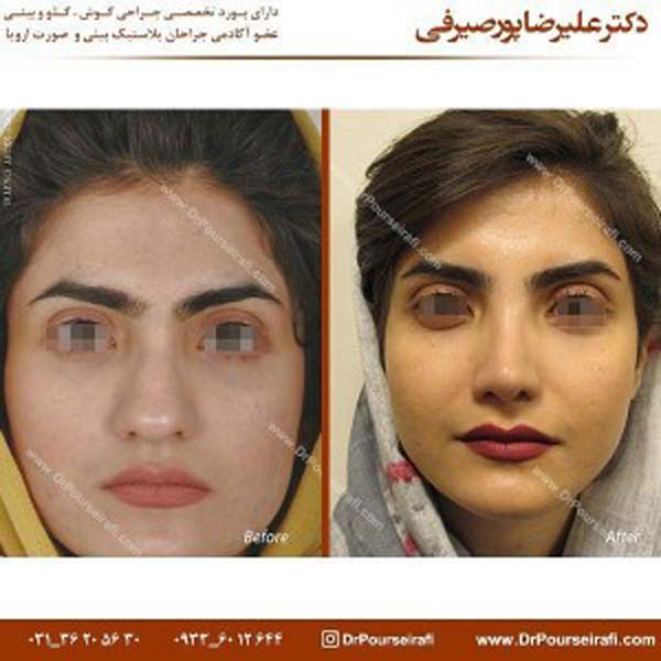 جراحی بینی طبیعی در اصفهان