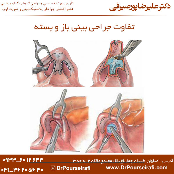 تفاوت جراحی بینی باز و بسته