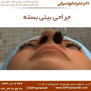 جراحی بینی بسته