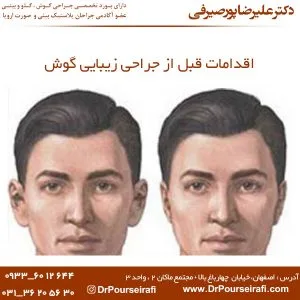 اقدامات قبل از جراحی زیبایی گوش
