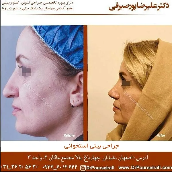 جراحی بینی استخوانی