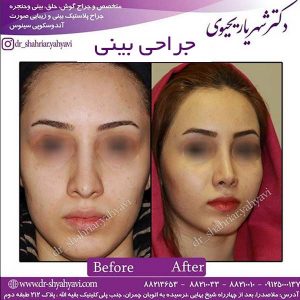 بهترین جراح بینی در اصفهان 4