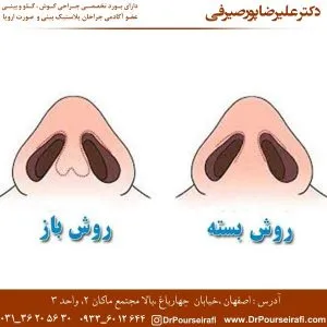 جراحی بینی بسته 2