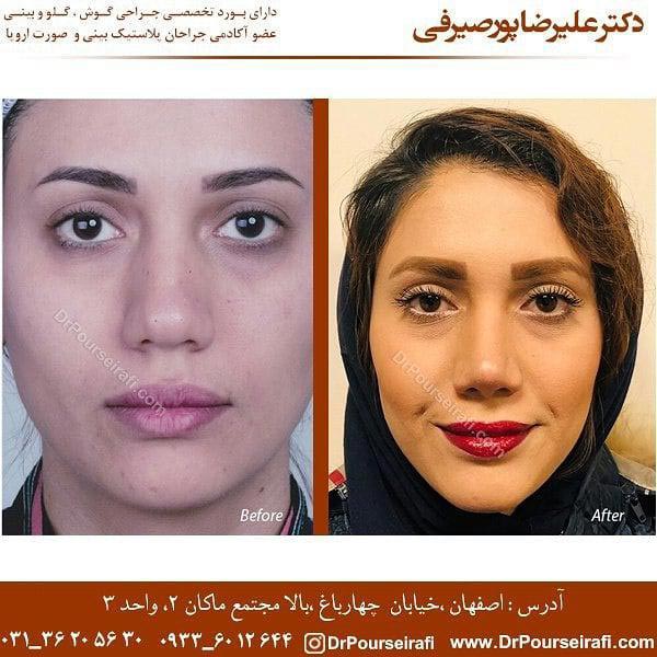 جراحی بینی در اصفهان - دکتر علیرضا پورصیرفی