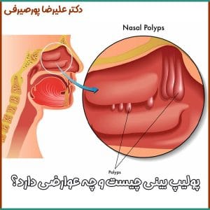 درمان پولیپ بینی در اصفهان _ دکتر علیرضا پورصیرفی