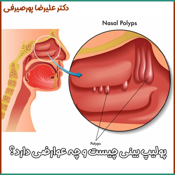 پولیپ بینی