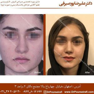 نمونه کار جراحی بینی گوشتی در اصفهان _ دکتر علیرضا پورصیرفی