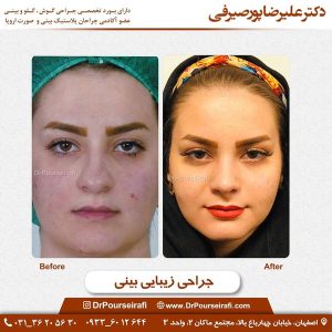 قبل و بعد جراحی بینی گوشتی در اصفهان _ دکتر علیرضا پورصیرفی