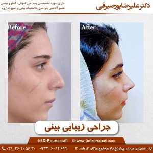 قبل و بعد عمل بینی گوشتی در اصفهان _ دکتر علیرضا پورصیرفی