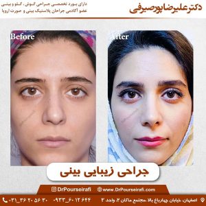 نمونه کار عمل بینی گوشتی در اصفهان _ دکتر علیرضا پورصیرفی