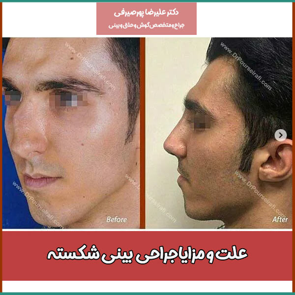 عکس قبل و بعد از جراحی بینی شکسته