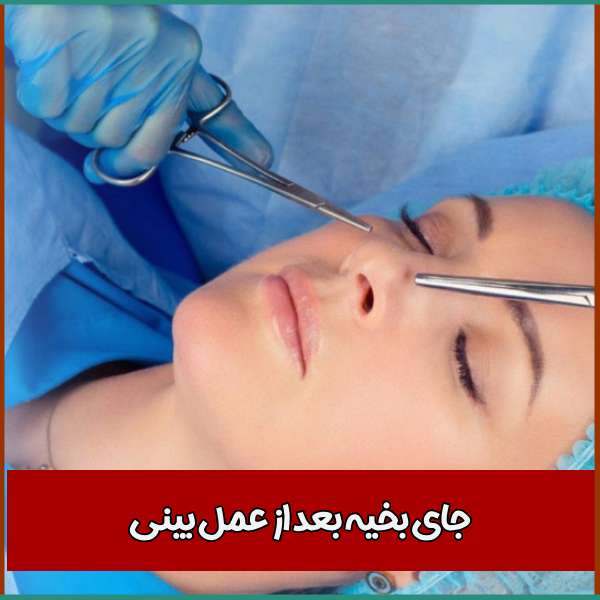 جای بخیه بعد از عمل بینی