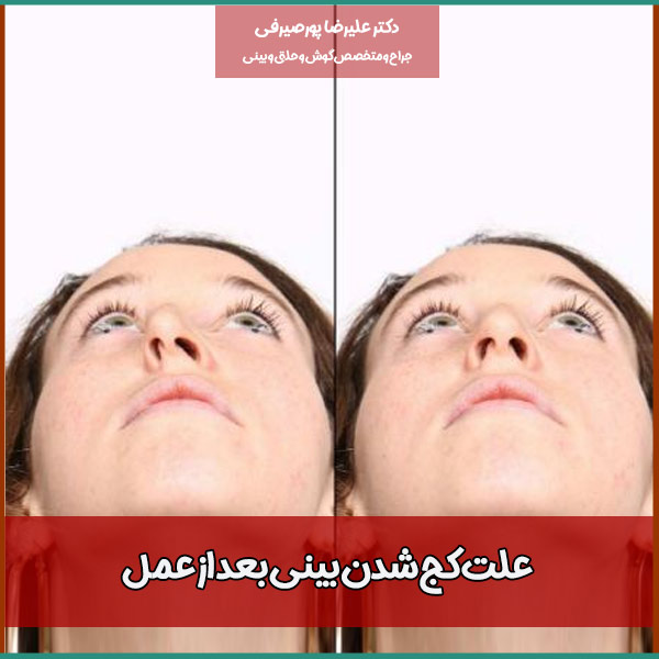 علت کج شدن بینی بعد از عمل + عوارض و نحوه درمان کجی بینی