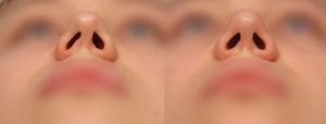 تصویر ناقرینگی سوراخ های بینی بعد از عمل _ دکتر علیرضا پورصیرفی
