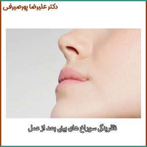 درمان ناقرینگی سوراخ های بینی بعد از عمل _ دکتر علیرضا پورصیرفی