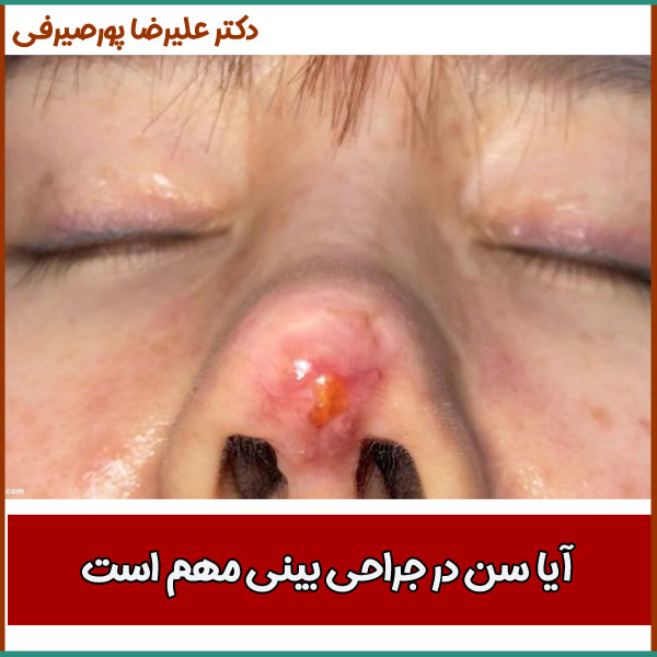 نکروز بینی _ دکتر علیرضا پورصیرفی