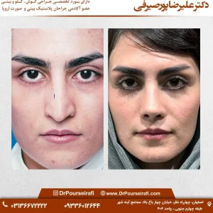 عمل بینی ترمیمی _ دکتر علیرضا پورصیرفی