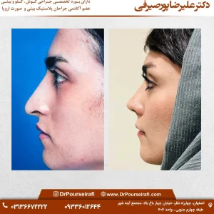 عمل بینی ترمیمی _ دکتر علیرضا پورصیرفی