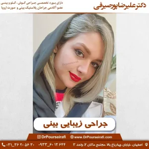 نمونه کار دکتر عمل بینی در اصفهان _ دکتر علیرضا پورصیرفی