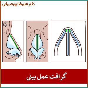 گرافت عمل بینی _ دکتر علیرضا پورصیرفی