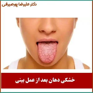 خشکی دهان بعد از جراحی بینی _ دکتر علیرضا پورصیرفی