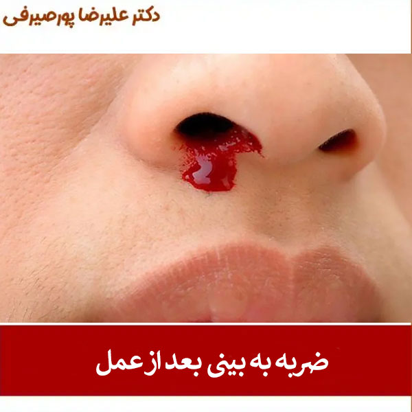 ضربه به بینی بعد از عمل _ دکتر علیرضا پورصیرفی