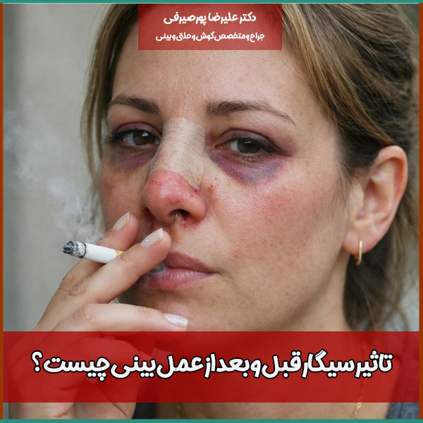 تاثیر سیگار قبل و بعد از عمل بینی چیست؟