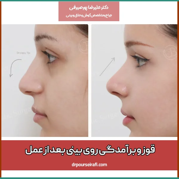 قوز و برآمدگی روی بینی بعد از عمل - دکتر پورصیرفی