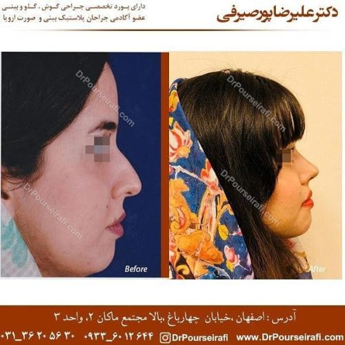جراحی بینی